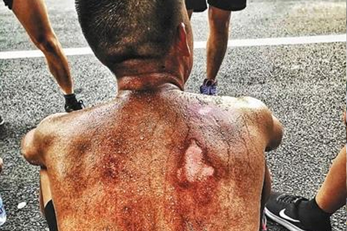 90后消防员背部受伤刷屏 称磨破皮"很正常"- 椰视频